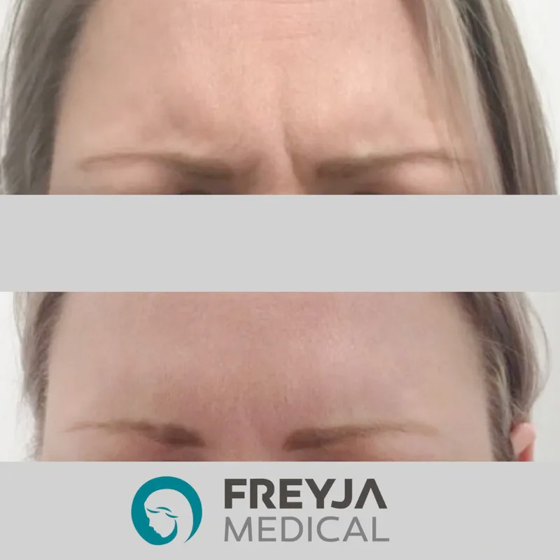 botox for frown lines in nantwich