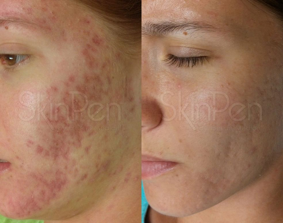 Acne Scars Freyja Medical