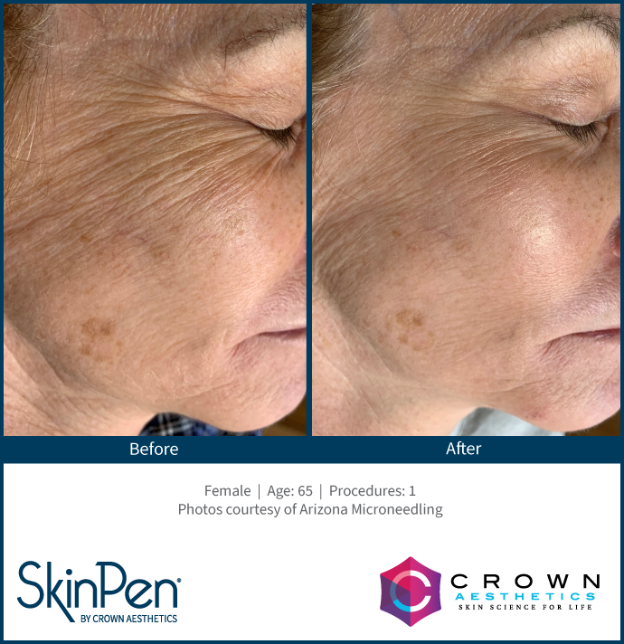 Microneedling for Anti-Aging: Before and After Image