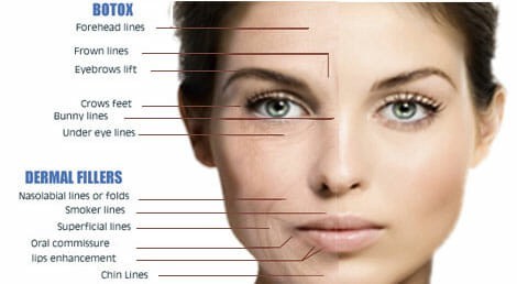 Difference between Botox and Fillers