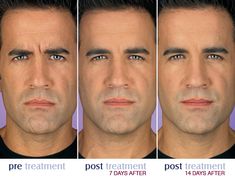 The Number of Male Botox Treatments is Soaring.