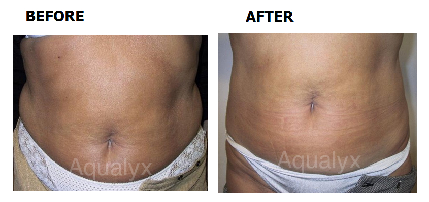 Aqualyx before and after 