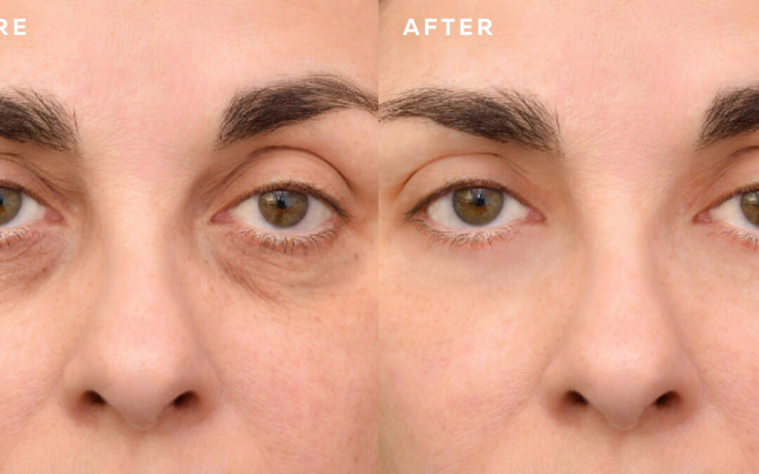 Tear Trough Filler Before And After Image