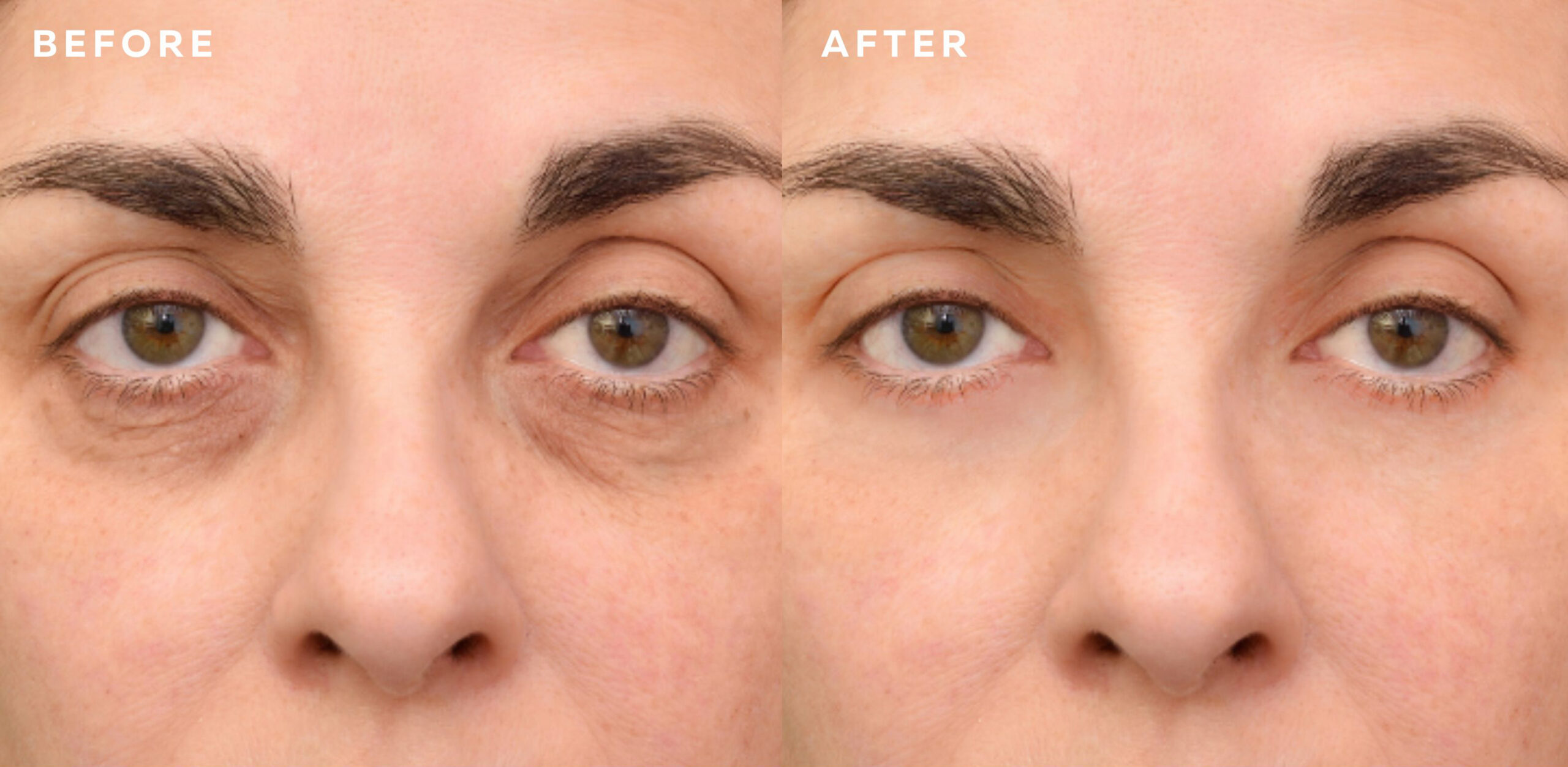 Tear Trough Filler Before And After Image