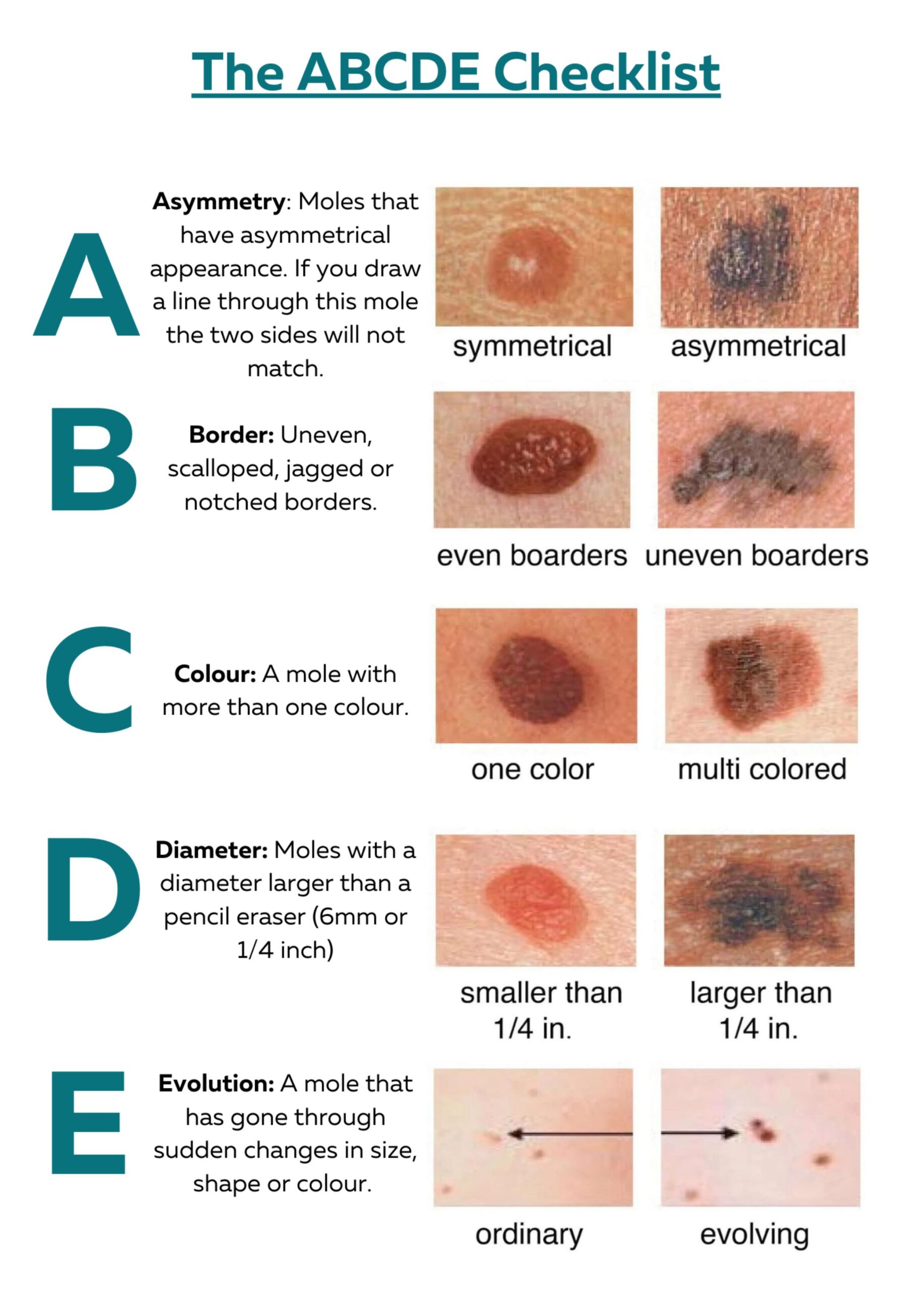 Early Detection of Melanoma: ABCDE Mole Check Guide