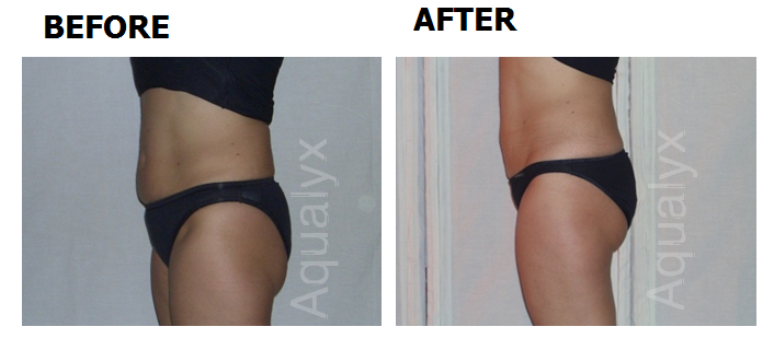 aqualyx before & after