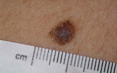How to do a mole check for skin cancer part 1