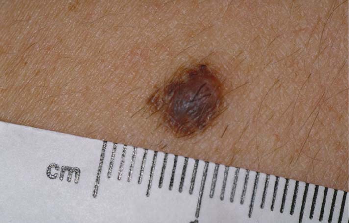 Early Detection of Skin Cancer: Mole Check 101