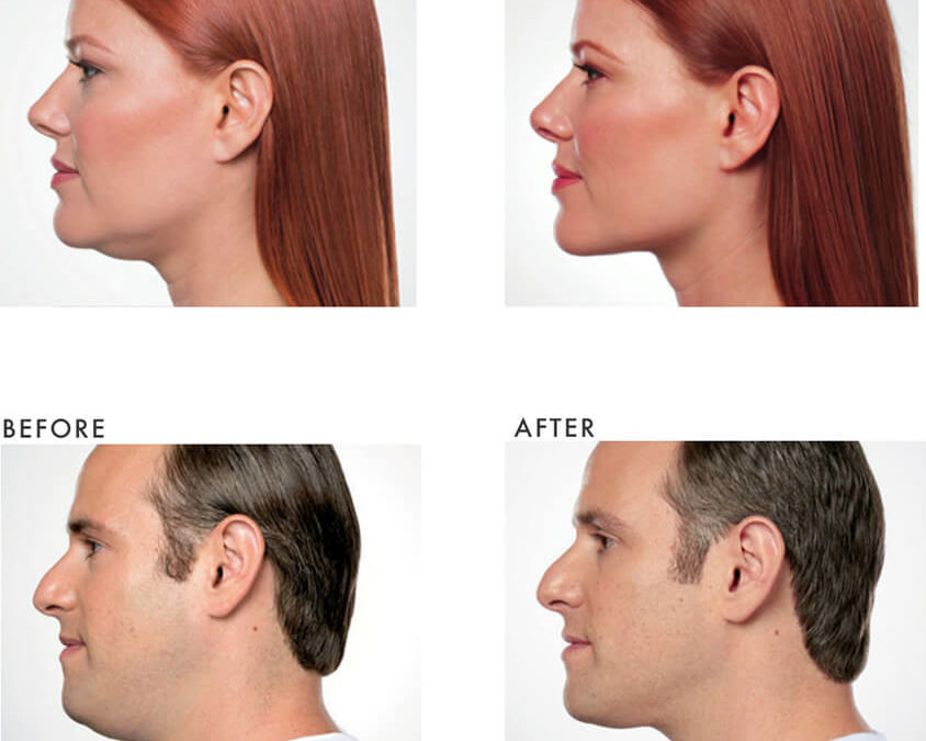 Say Goodbye to Your Double Chin with Aqualyx
