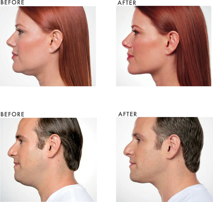 Chin Injections to Reduce Fat Beneath the Jawline