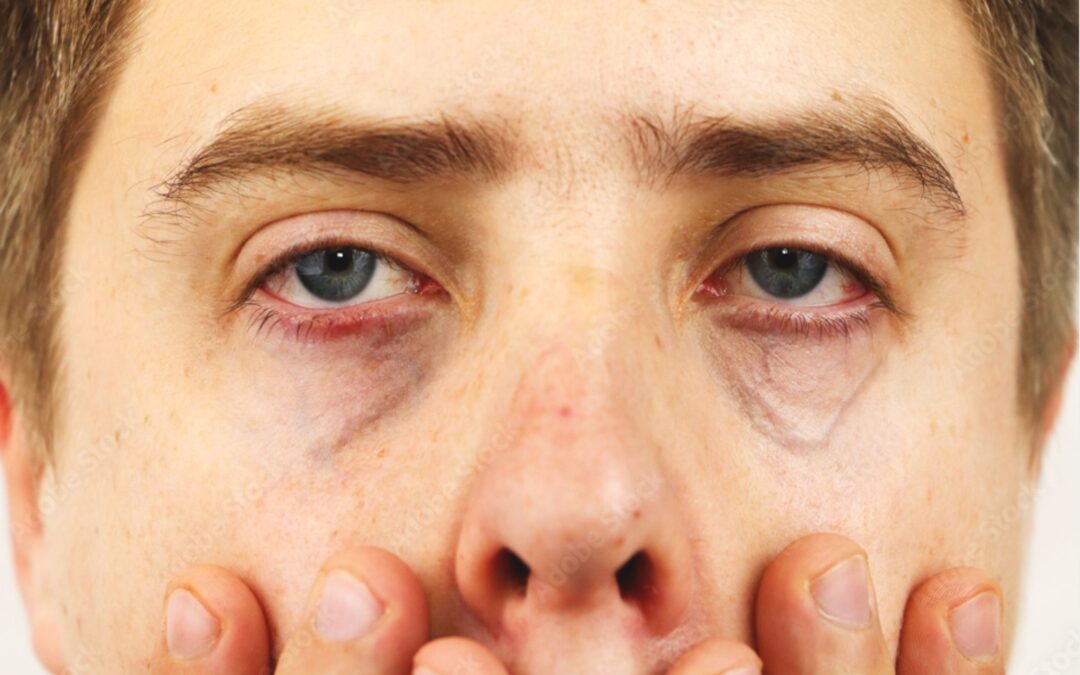 Tired Eyes: Dermal Fillers for Tear Trough at Freyja Medical