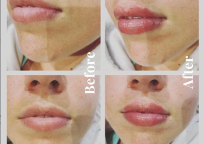 Lips before and after
