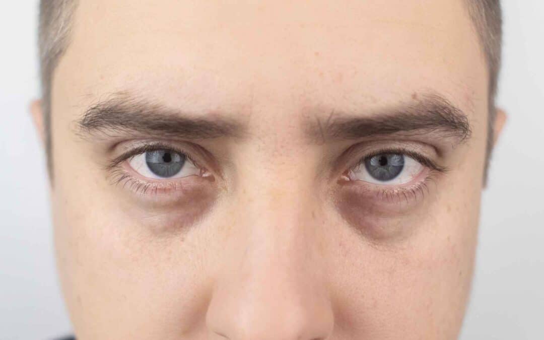 Tired Eyes? Revitalise with Tear Trough Fillers!