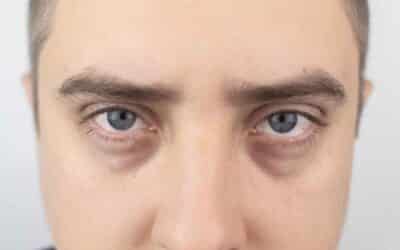 Tired Eyes? Revitalise with Tear Trough Fillers!