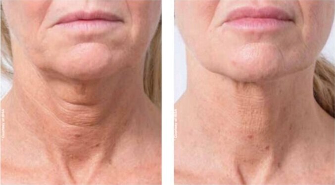 profhilo neck Neck Profhilo