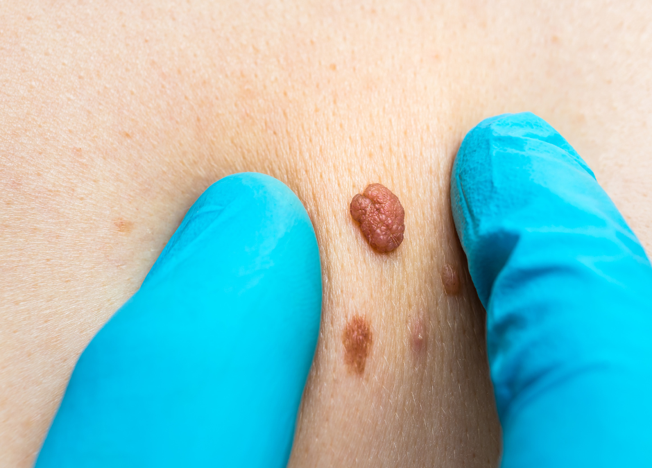 Say Goodbye to Skin Tags – Expert Skin Tag Removal Service