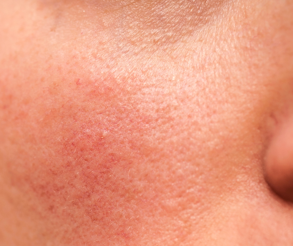 face redness