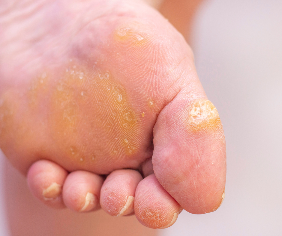 verruca treatment verruca treatment