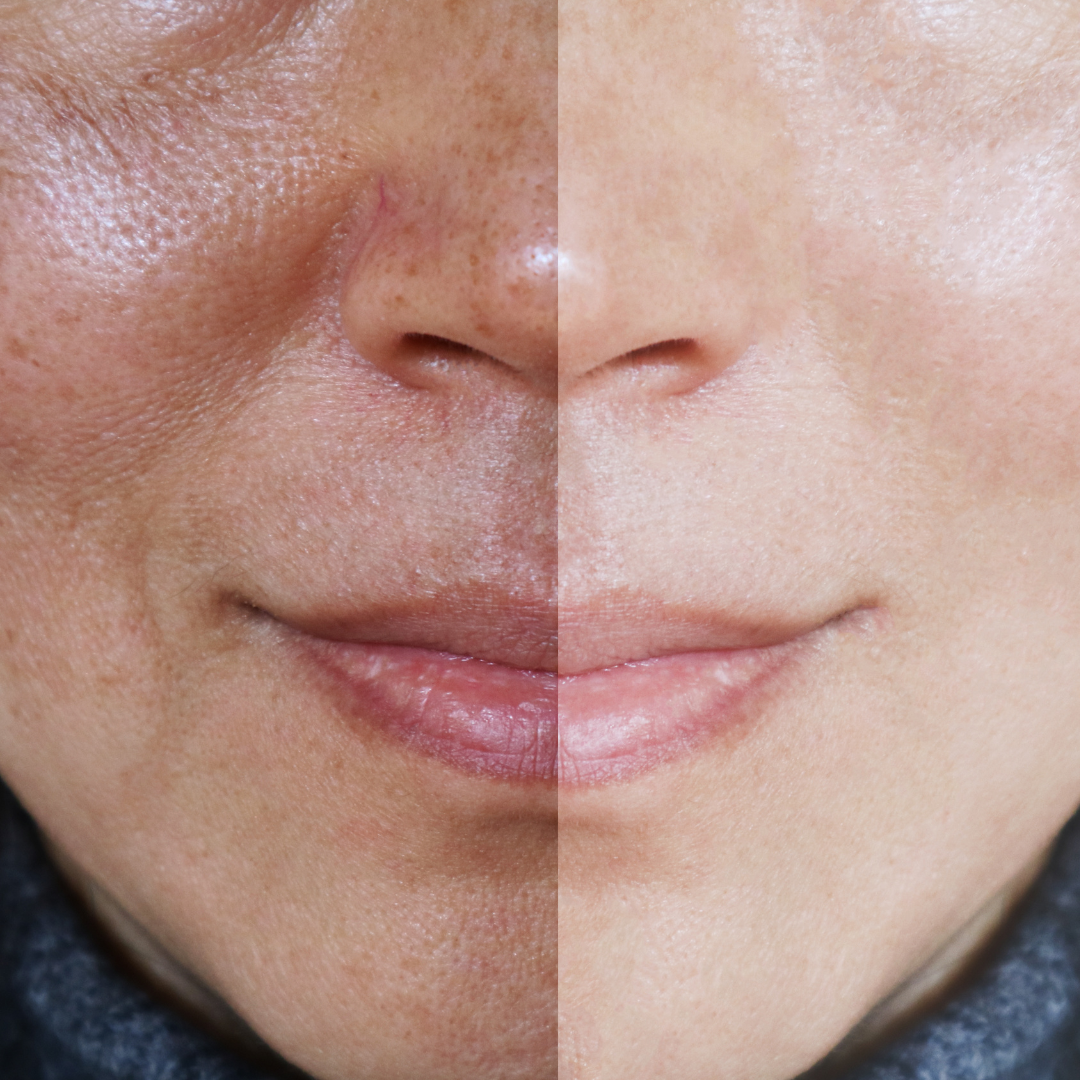 Untitled design (57) Melasma before and after