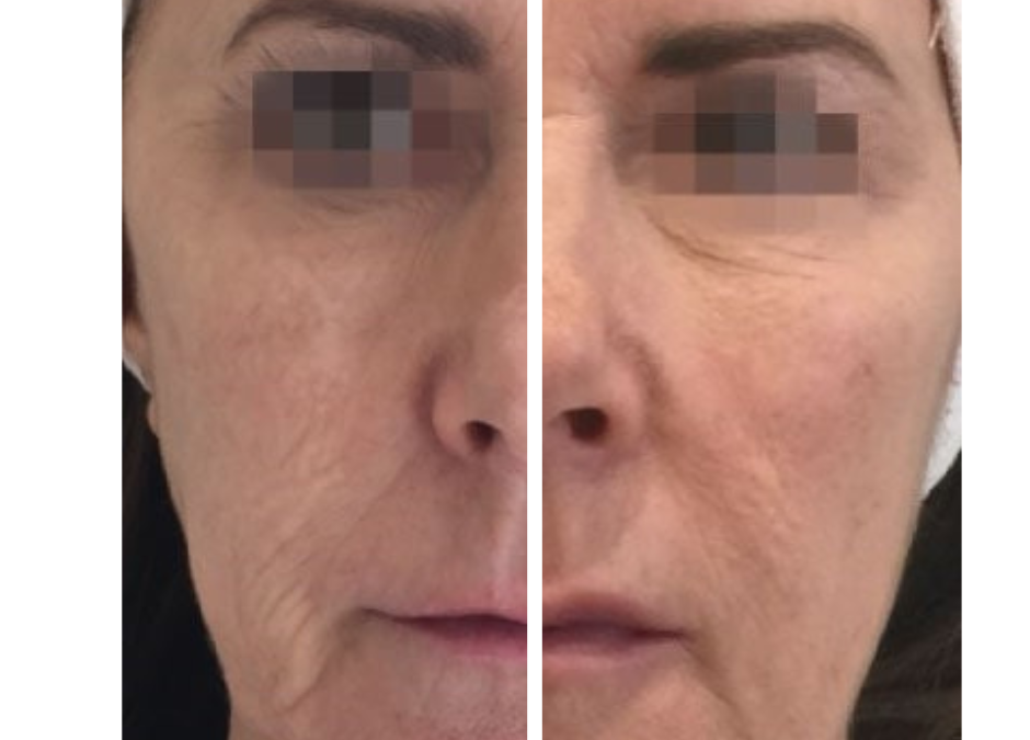 Seeing is Believing: Profhilo Before and After Results
