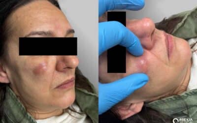 Dermal Filler Lumps: Identification & Management