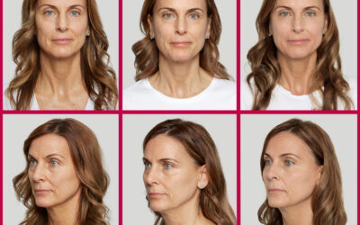 What is the difference between Sculptra and Dermal Fillers?