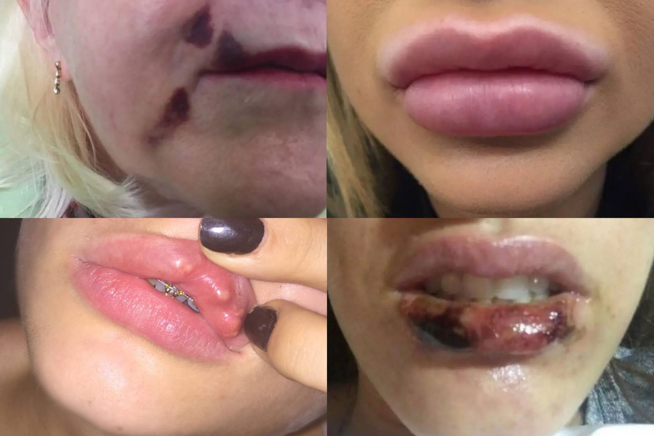 Leslie Ash Lips: What Can Go Wrong with Lip Fillers?