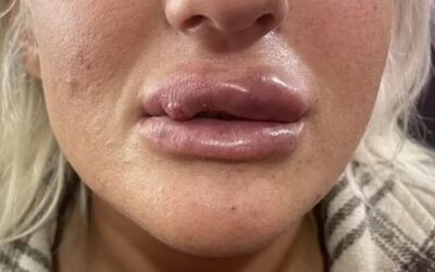 Dermal Filler Lumps: Identification & Management
