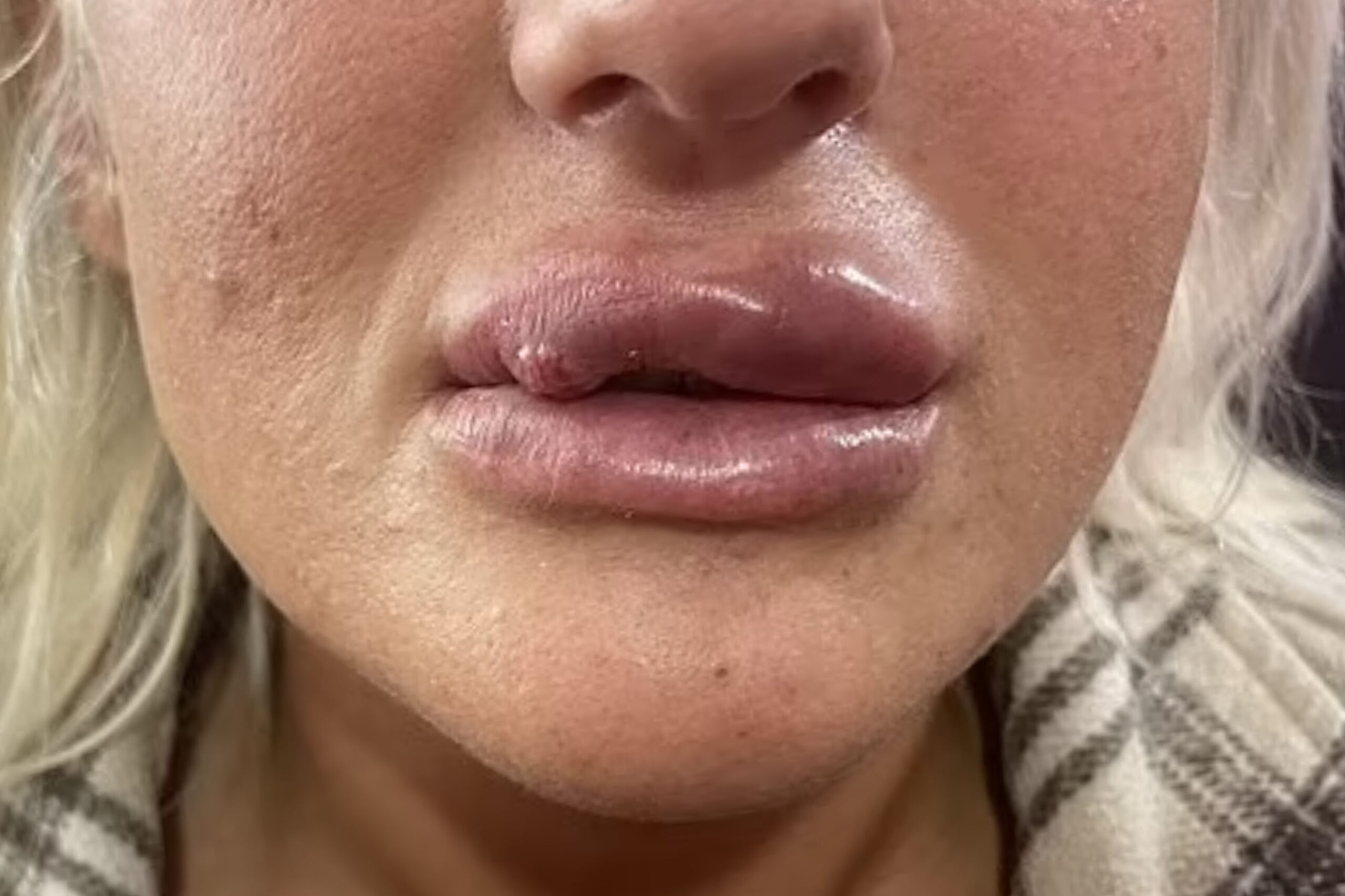 Leslie Ash Lips: How to Avoid the Leslie Ash Effect