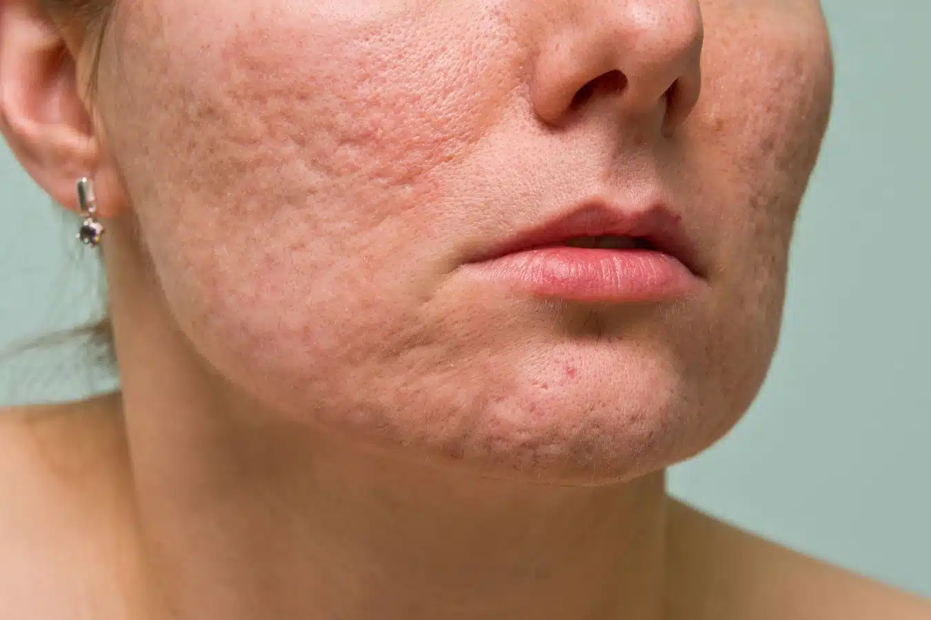 Acne Scars