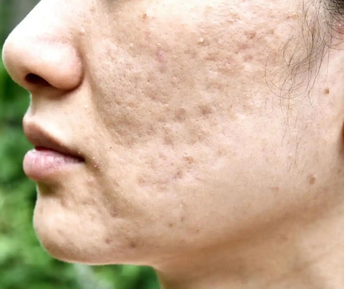 Acne Scars