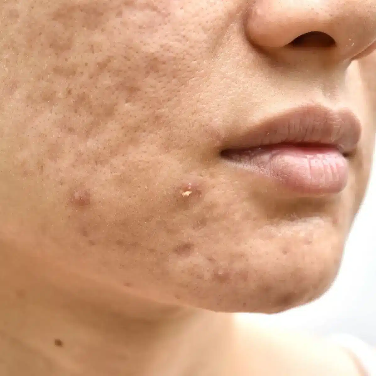 Acne Scars
