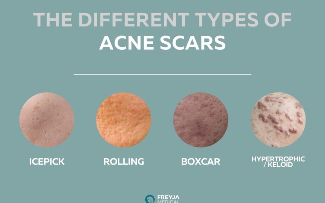 Types of Acne Scars, Treatments and Prevention