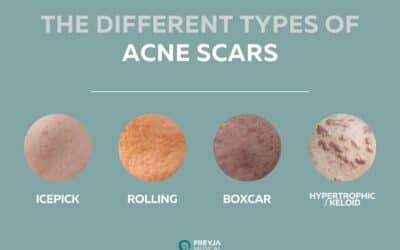 Types of Acne Scars, Treatments and Prevention