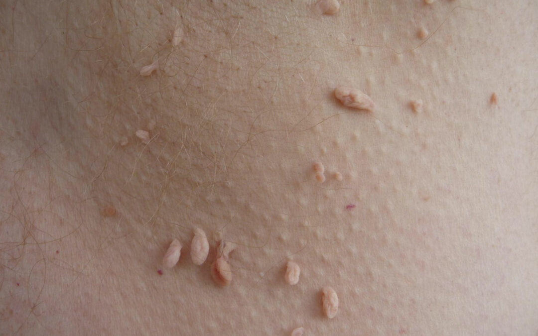 5 Reasons to See a Dermatologist for Skin Tag Removal