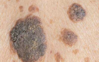 Seborrhoeic Keratoses: Safe Treatment Options