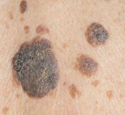 Seborrhoeic Keratosis – What they are and how to get rid of them