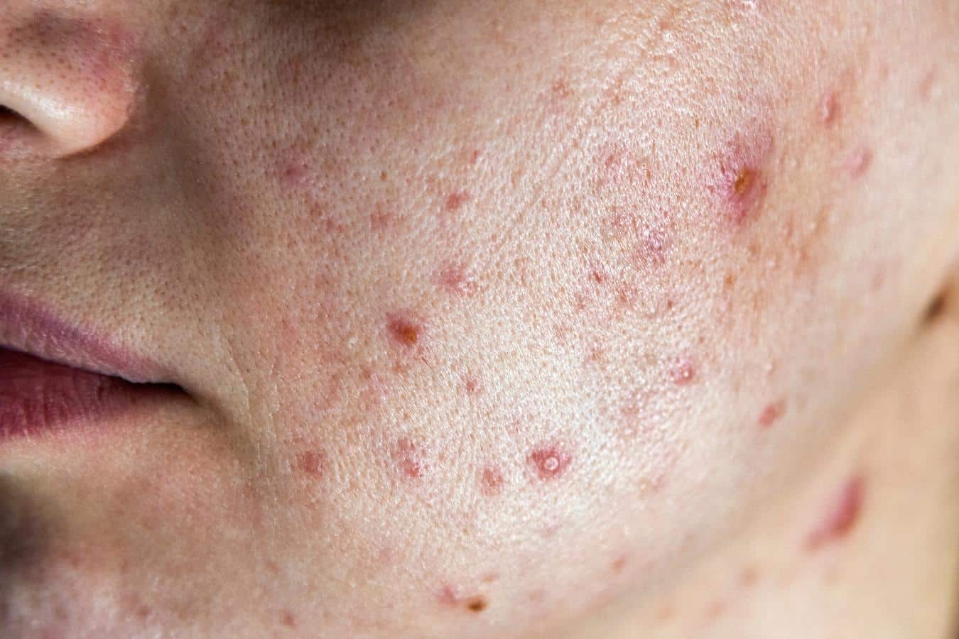 Hormonal acne 