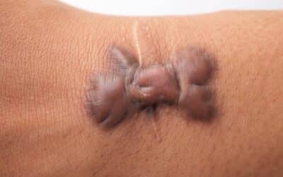 Why Home or Salon Mole Removal Is a Bad Idea