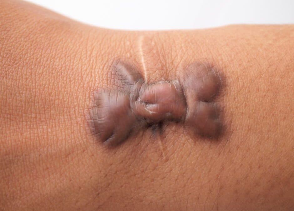 Why Home or Salon Mole Removal Is a Bad Idea