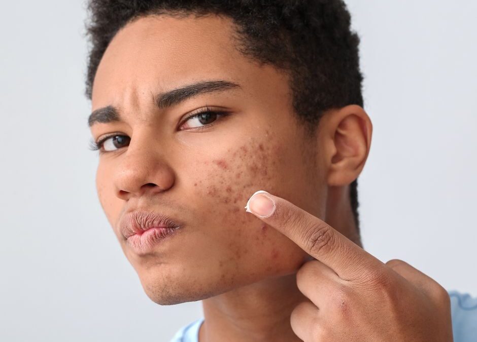 Acne Products Watch: What to Look for in Skincare Ingredients