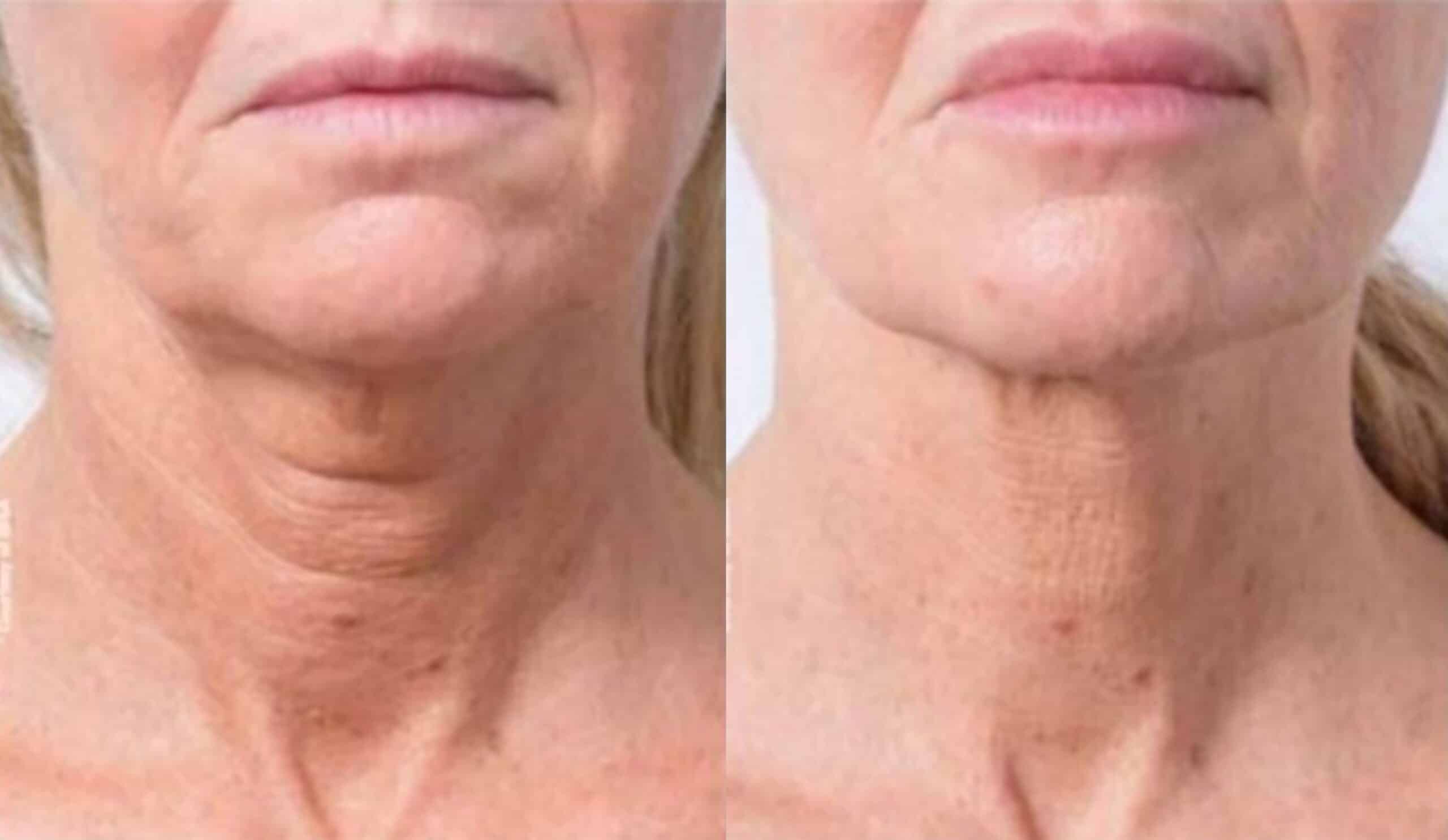 Profhilo for Skin Rejuvenation