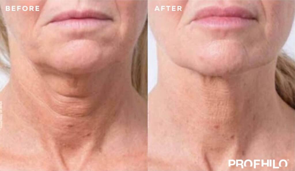 Profhilo for Skin Rejuvenation