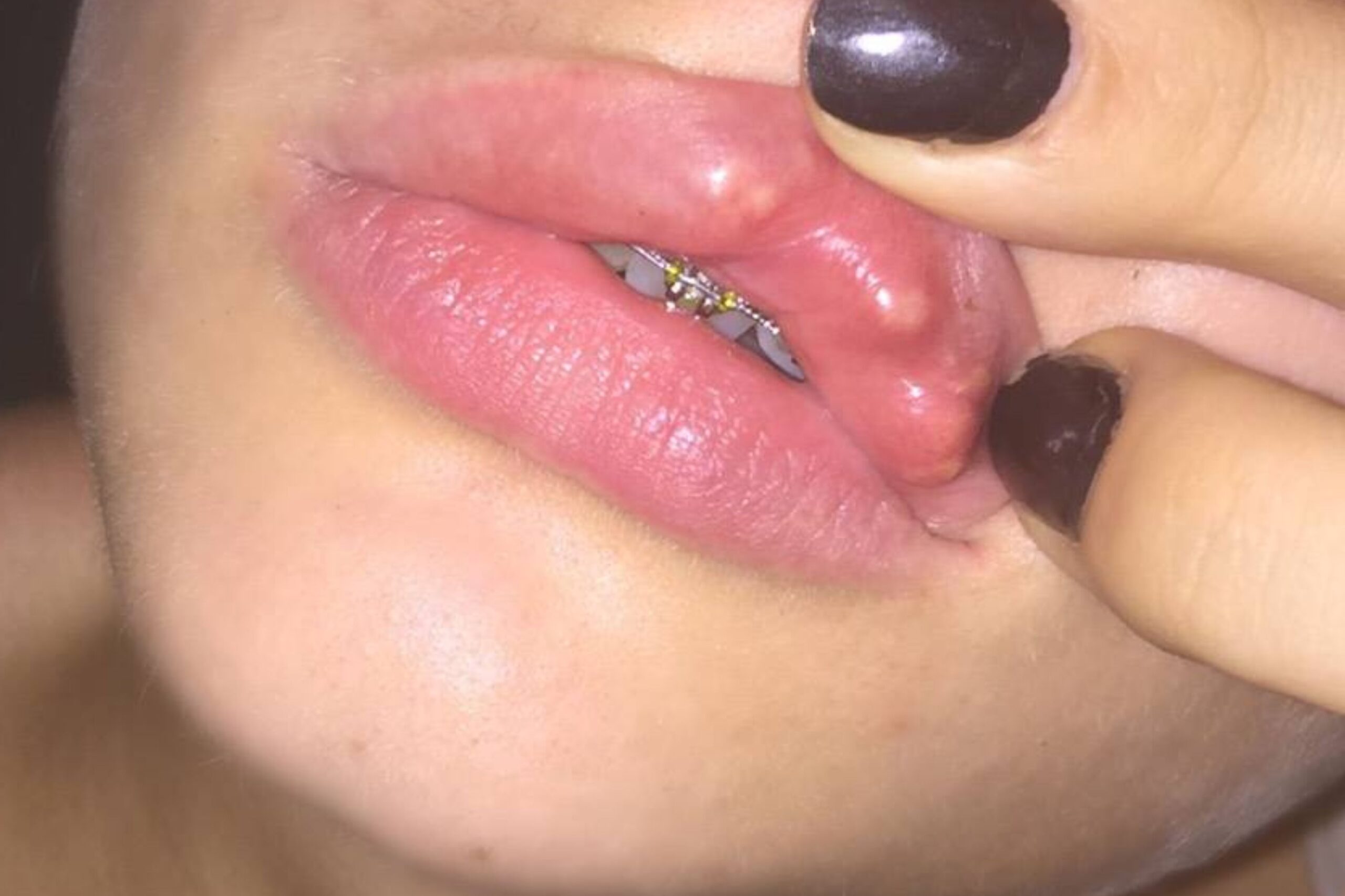 Dermal Filler Lumps