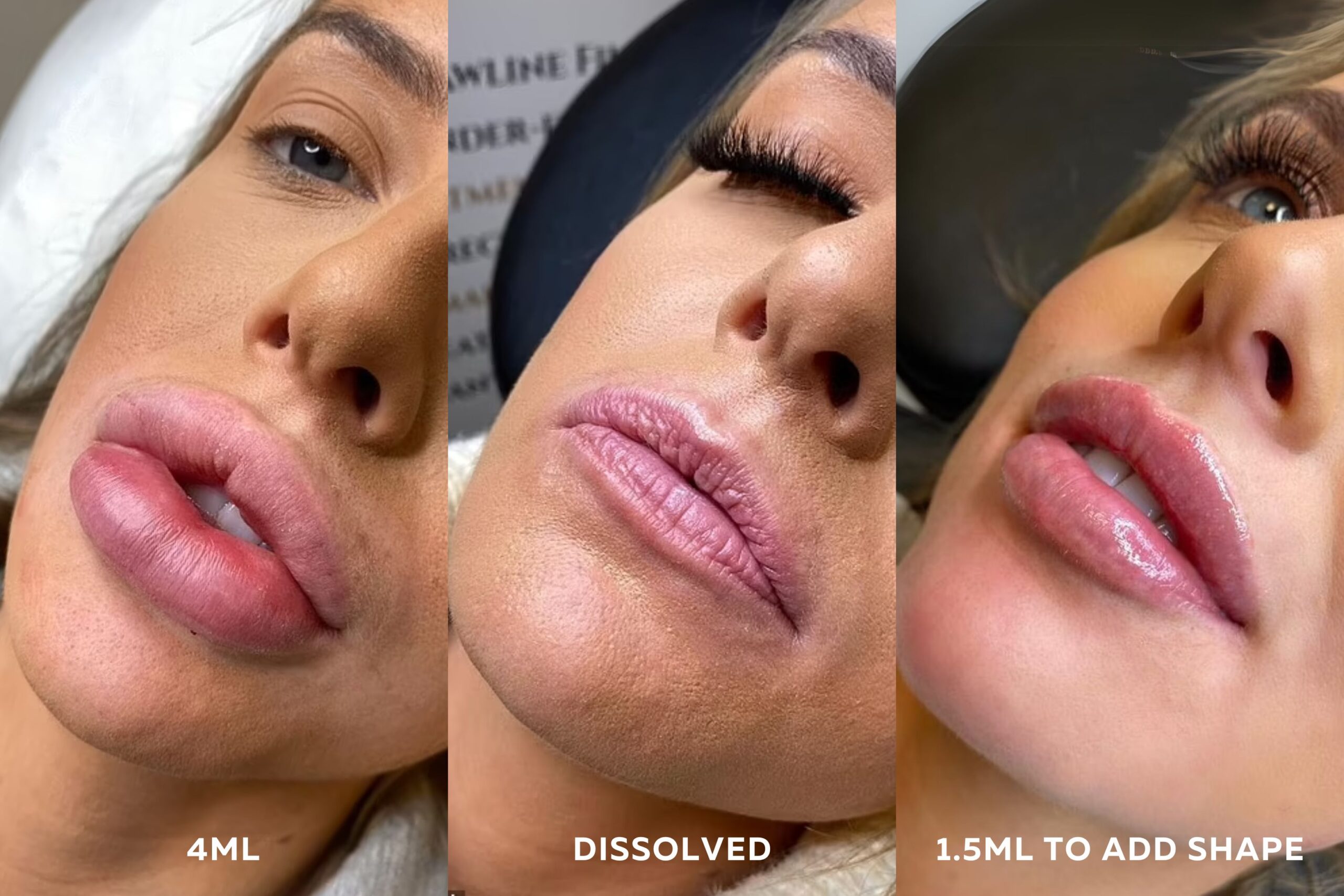 Dissolving Dermal Filler: Love Island Faye Winter Lips