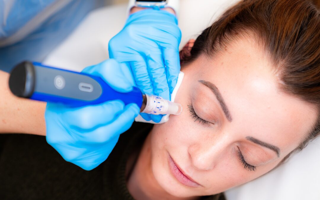 Microneedling for Anti-Aging: A Celeb-Favoured Trend