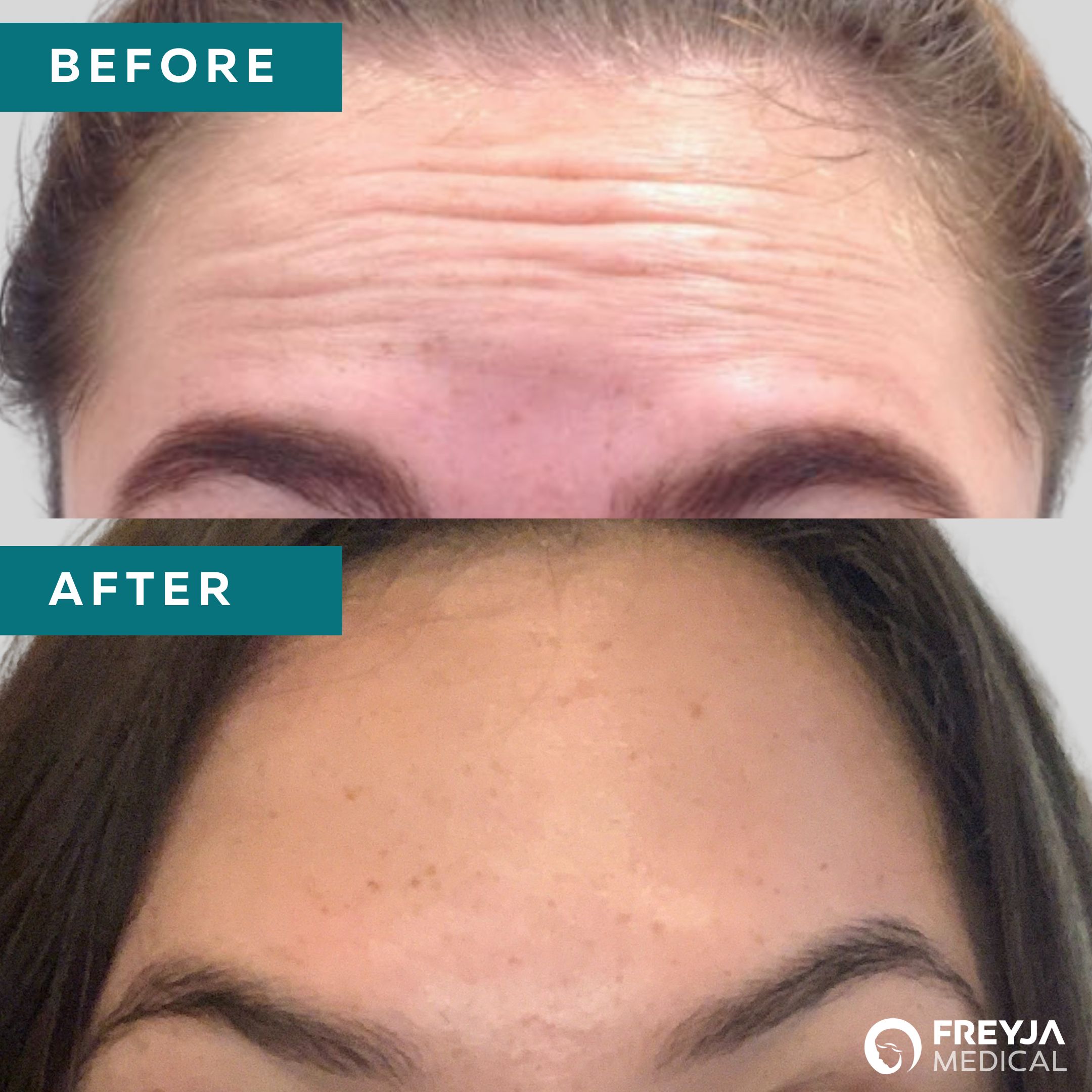 Before and After, anti-wrinkle treatment for forehead lines