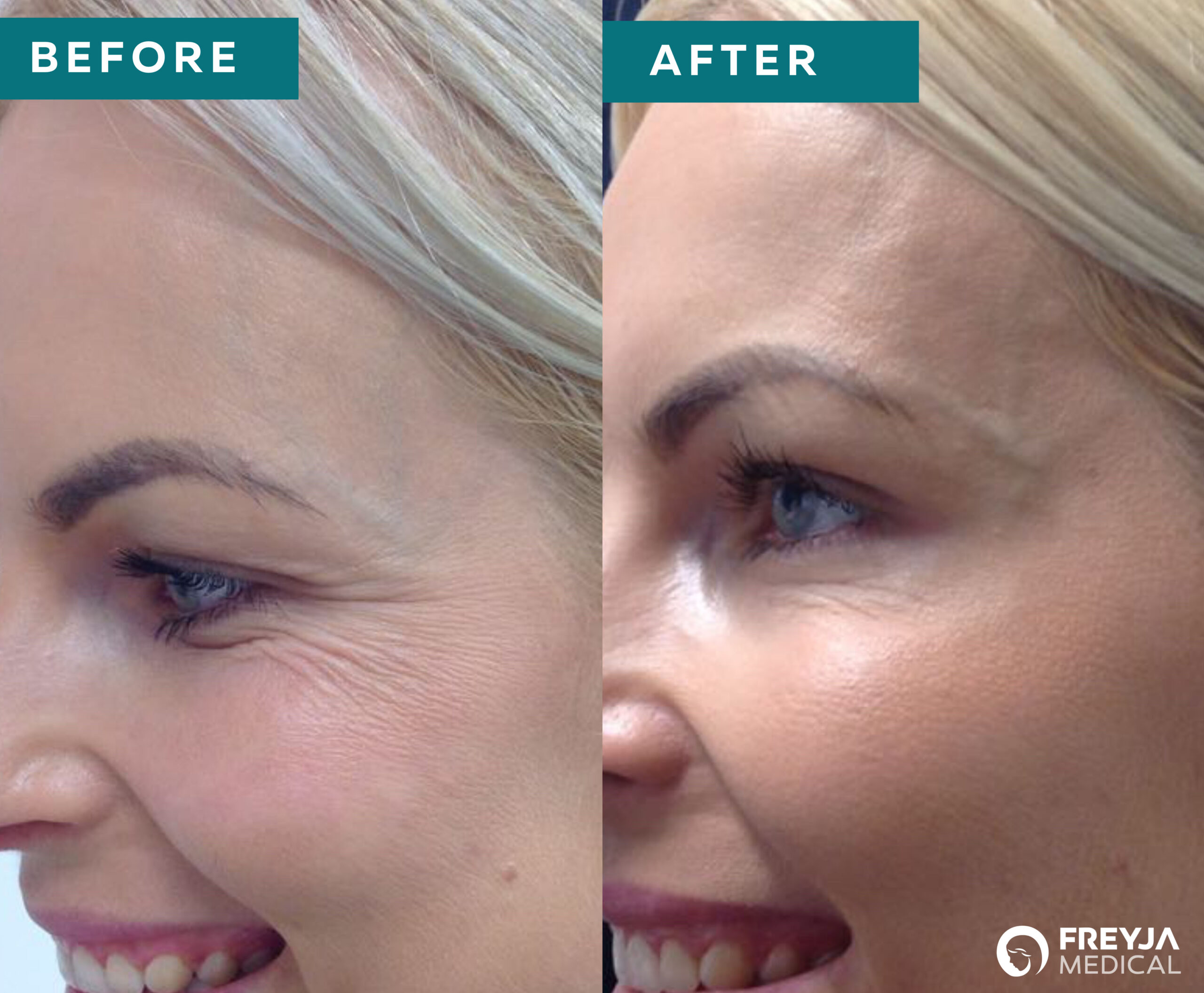 Anti-Wrinkle Treatment for Crows Feet at Freyja Medical. Before and After Image