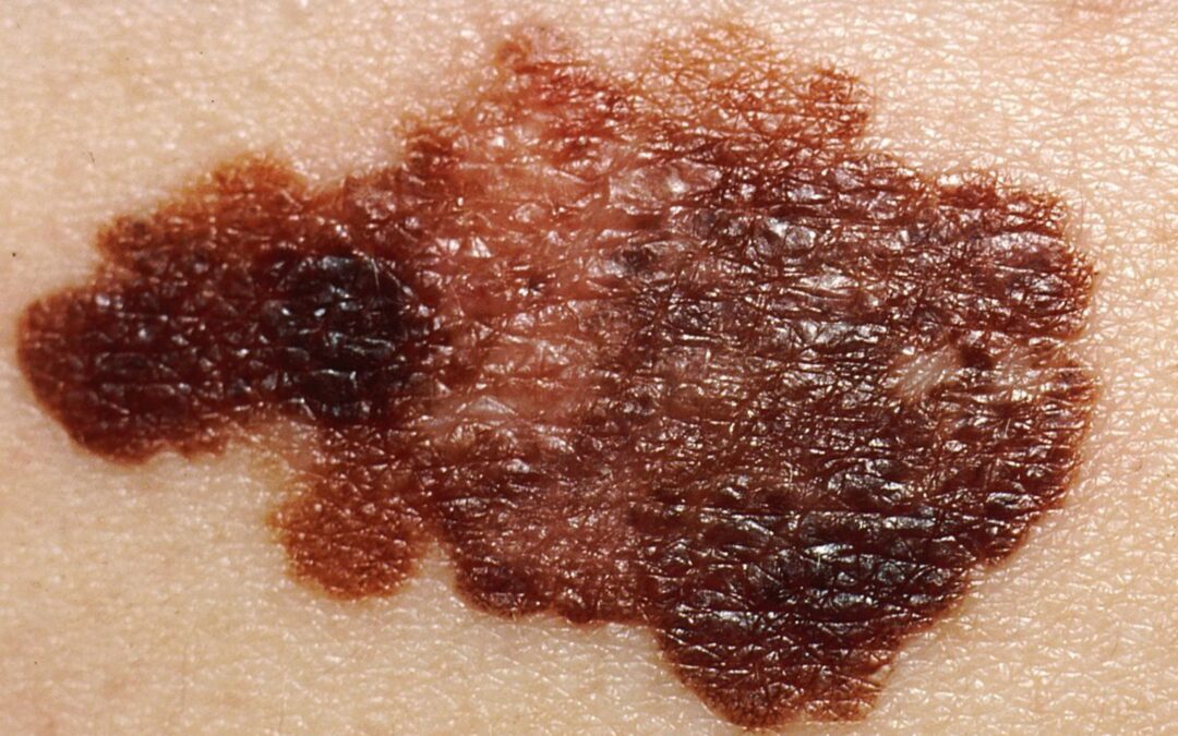 Early Detection of Melanoma: Mole Check 101