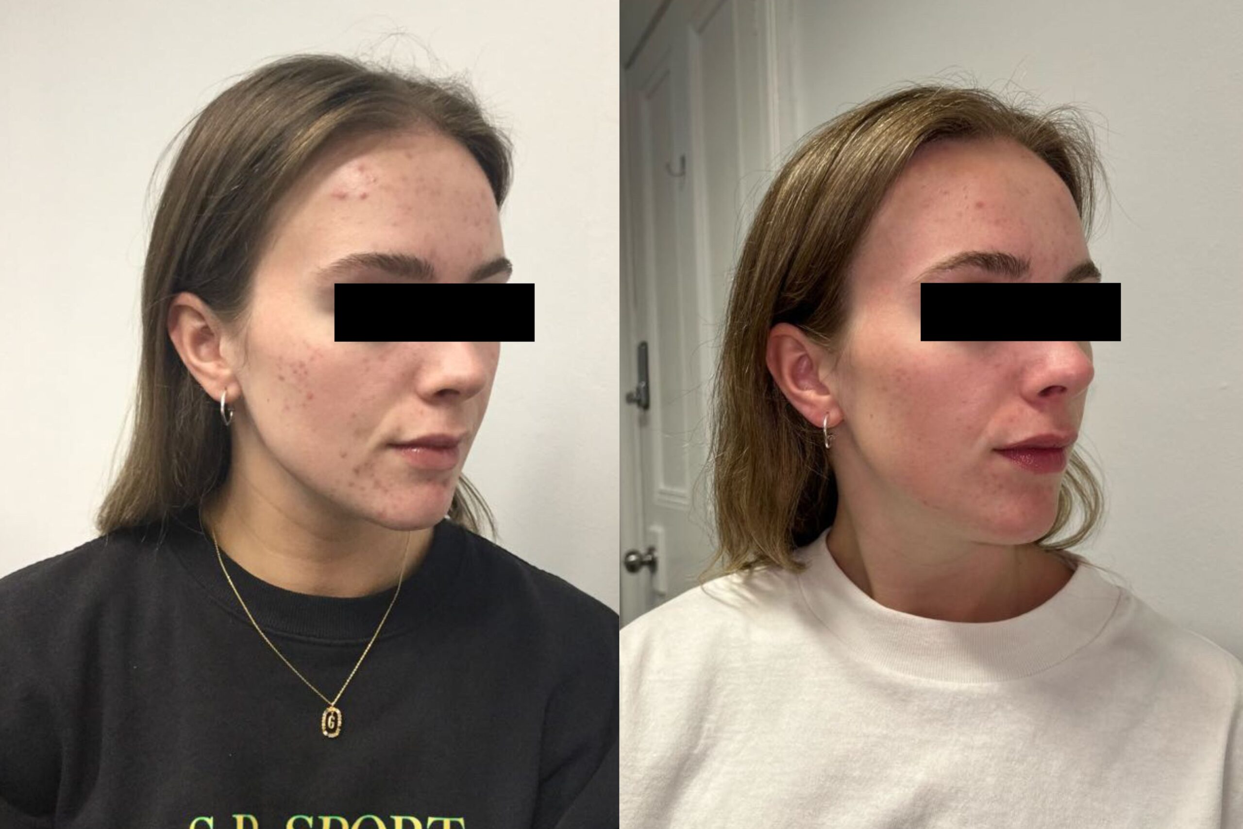 Skin Peel Treatment for Acne: Before and After